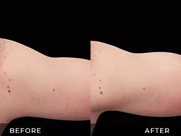 Emsculpt Before After