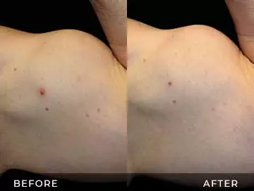 Emsculpt Before After