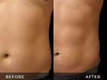 Emsculpt Before After