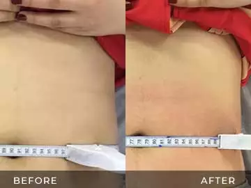 Emsculpt Before After