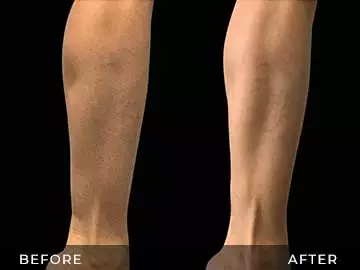 Emsculpt Before After