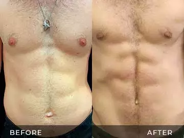Emsculpt Before After