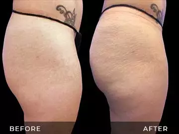 Emsculpt Before After