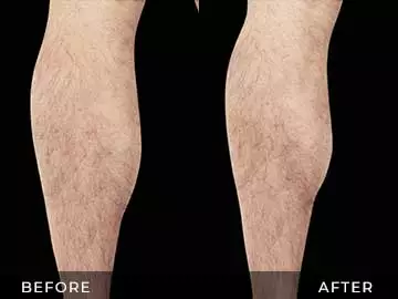 Emsculpt Before After